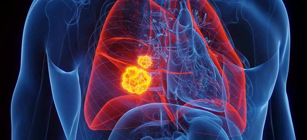Απεικόνιση καρκίνου πνεύμονα σε 3D διάγραμμα ανθρώπινου σώματος